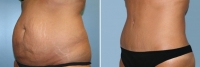 Abdominoplastia_10