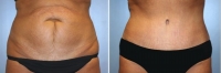 Abdominoplastia_11