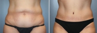 Abdominoplastia_13