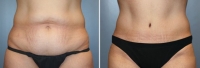 Abdominoplastia_14