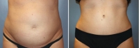 Abdominoplastia_16