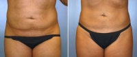 Abdominoplastia_1