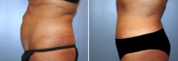 Abdominoplastia_2