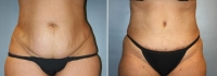 Abdominoplastia_3