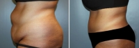 Abdominoplastia_5