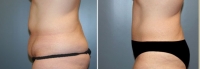 Abdominoplastia_6