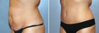 Abdominoplastia_8