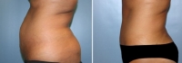 Abdominoplastia_9