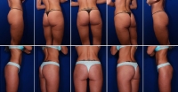 Aumento de gluteos por infiltracion de grasa_2