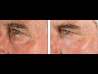 Blefaroplastia