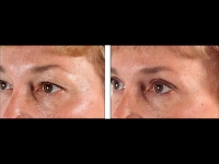 Blefaroplastia