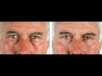 Blefaroplastia