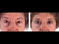 Blefaroplastia