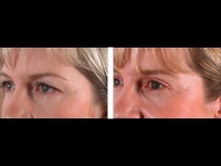 Blefaroplastia