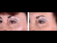 Blefaroplastia