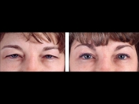 Blefaroplastia