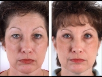 Blefaroplastia