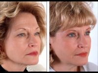 Blefaroplastia