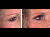 Blefaroplastia