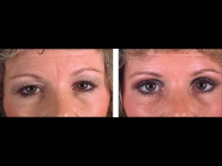 Blefaroplastia