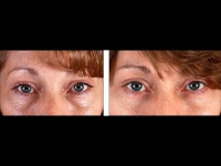 Blefaroplastia