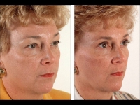 Blefaroplastia