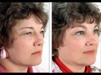 Blefaroplastia