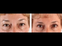 Blefaroplastia