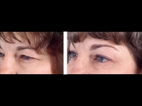 Blefaroplastia