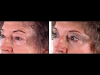 Blefaroplastia