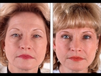 Blefaroplastia