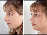 Rinoplastia