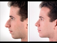 Rinoplastia