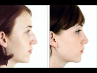 Rinoplastia