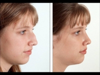 Rinoplastia