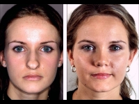 Rinoplastia