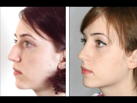 Rinoplastia