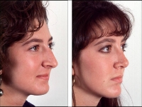 Rinoplastia