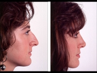 Rinoplastia