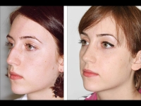 Rinoplastia