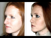 Rinoplastia