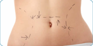 abdominoplastia