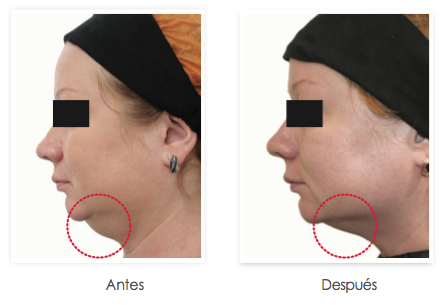 antes y despues 2